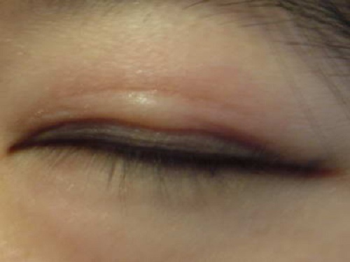 Phẫu thuật cắt mí mắt trên dưới góc nhìn chuyên gia 1