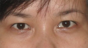 Phẫu thuật nâng mí mắt diễn ra như thế nào?