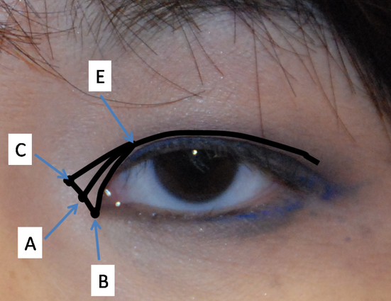 Phẫu thuật cắt khóe mắt như thế nào? 1