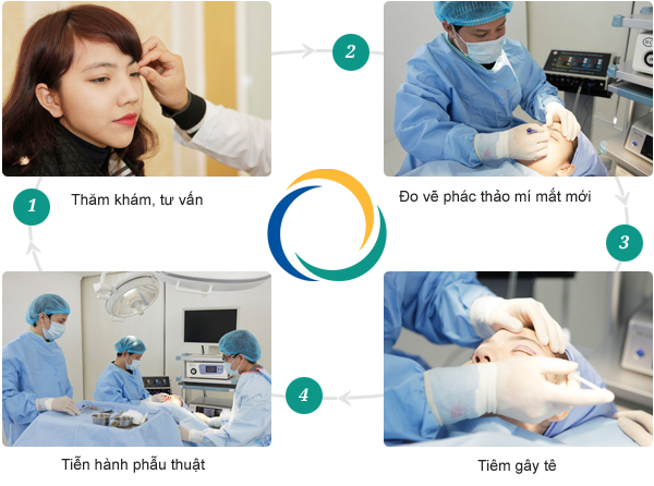 Bạn biết gì về phẫu thuật cắt mí mắt dưới công nghệ Hàn Quốc? 3