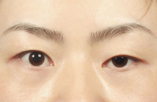 Phẫu thuật mắt to mắt nhỏ tại Hà Nội và 4 lưu ý QUAN TRỌNG không thể bỏ qua