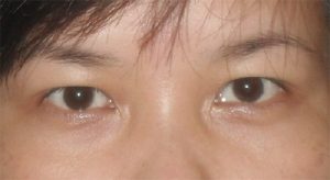 Bấm mí mắt có chữa được mắt một mí và bọng mắt dưới không?