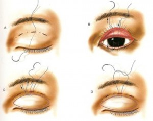 Phẫu thuật cắt mí mắt có an toàn không?