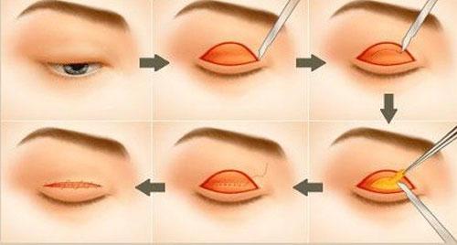 Phẫu thuật lấy bọng mỡ mắt, từ A đến Z cho bạn tìm hiểu