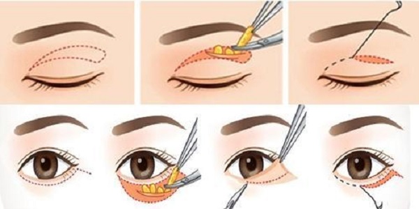 quy trình cắt mí mắt