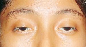 3 Cách chữa mắt híp, mắt nhỏ – cho mắt to tự nhiên
