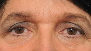 Sụp mí mắt ở người già có nên phẫu thuật không?