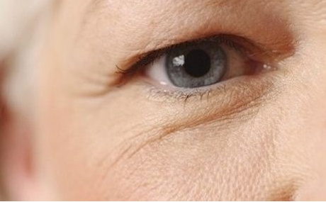 Sụp mí mắt ở người già có nên phẫu thuật không?