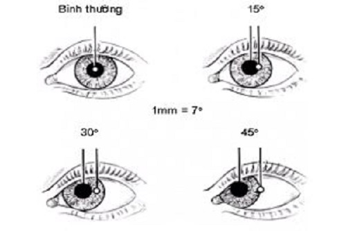 Sau phẫu thuật mắt tiếp tục được trị liệu phục hồi để hoàn thiện chức năng nhìn