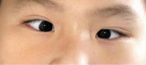 Điều trị mắt lé kịp thời để tránh những biến chứng đáng tiếc về mắt