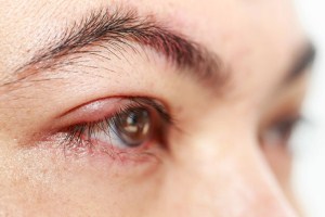 Cắt mí mắt có để lại sẹo không?