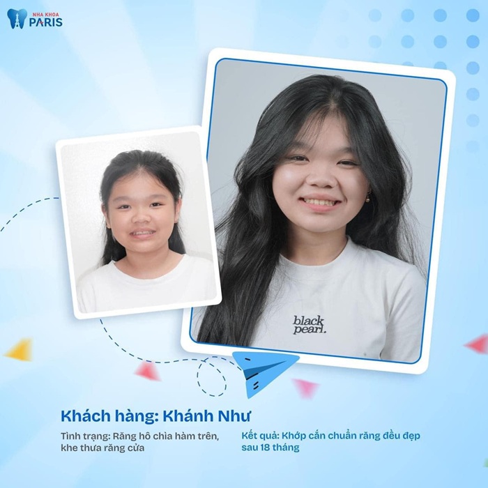Sự thay đổi rõ rệt trước khi sau khi làm răng